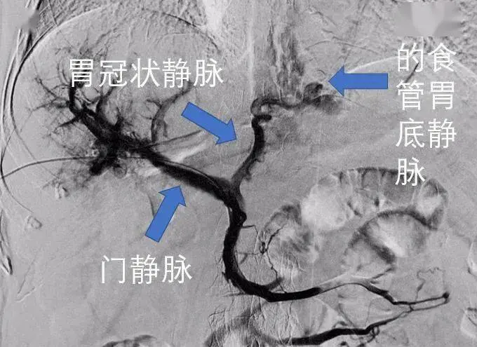 76岁白叟忽然很多呕血，医师在她脖子扎个针孔做手术