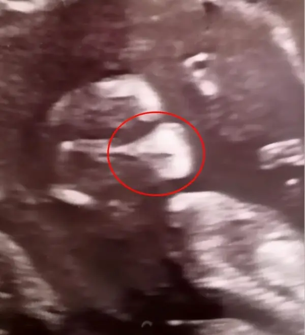 孕妈妈见B超相片吃惊：宝宝竟“戴着口罩”！更没想到不久竟然确诊