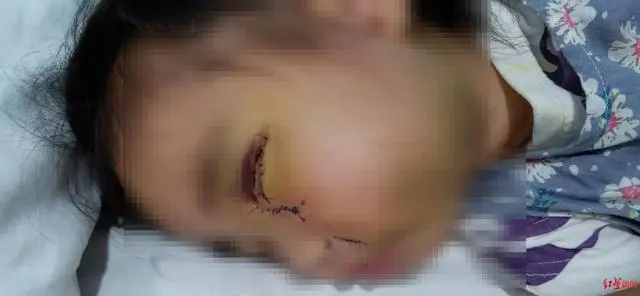 3岁女孩度假村被马咬伤 妈妈：眼睛、鼻、嘴变形，准备小学时整形