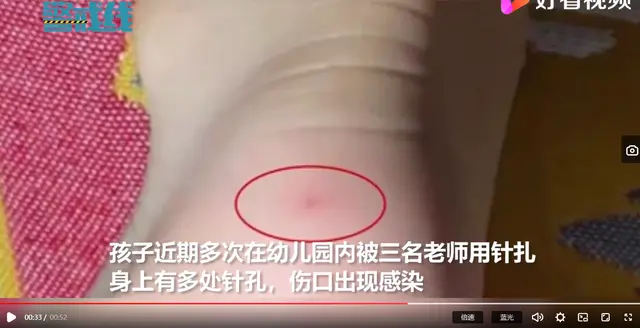 又现幼童疑遭扎针：深圳一幼儿园4岁幼童疑遭扎针，警方已介入