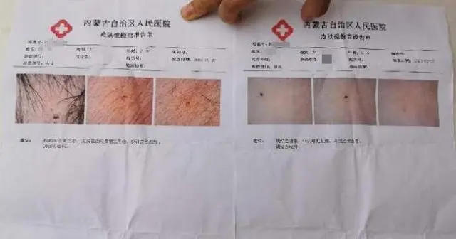 又现幼童疑遭扎针：深圳一幼儿园4岁幼童疑遭扎针，警方已介入