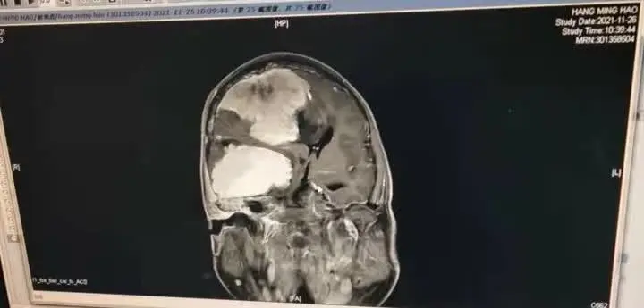 惊恐！扬州一患者肿瘤挤满半个脑袋，手术做了5个多小时，最终……