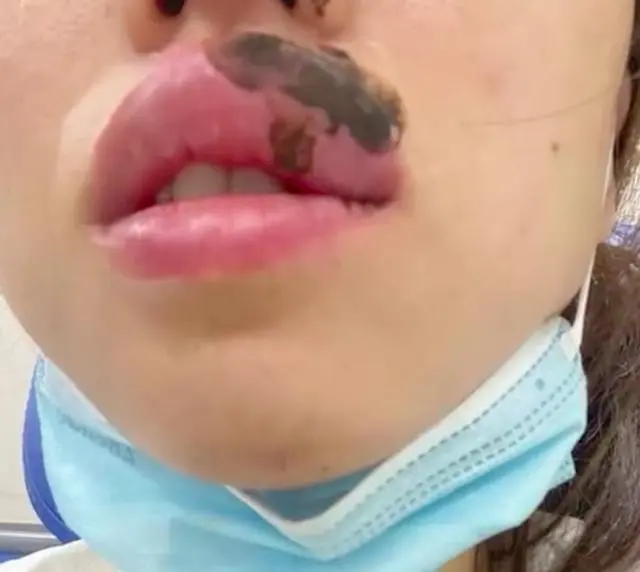 女子睡眠被蜈蚣咬醒，嘴肿成“腊肠”！当事东谈主：几秒钟就肿起来了，超乎思象的疼