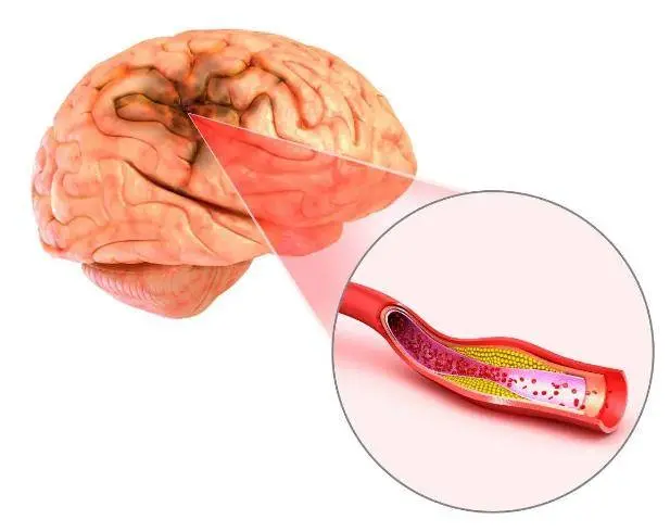 为什么脑梗逐渐增多？医生提醒：睡觉时常有5个异常，尽早检查