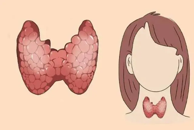 女子会诊出5cm甲状腺结节，3个月削弱了日本三级电影，大夫：她的作念法值得鉴戒