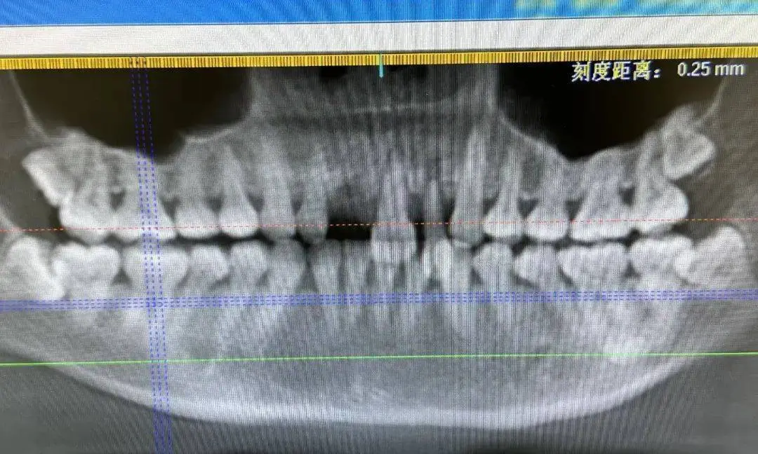 一晚上好几例！有东说念主磕掉3颗门牙！大夫：提议泡在牛奶里