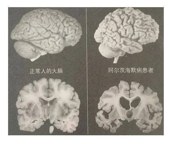 如何驻扎瓦解禁闭？ 7个关键助你保护好大脑，减速虚弱