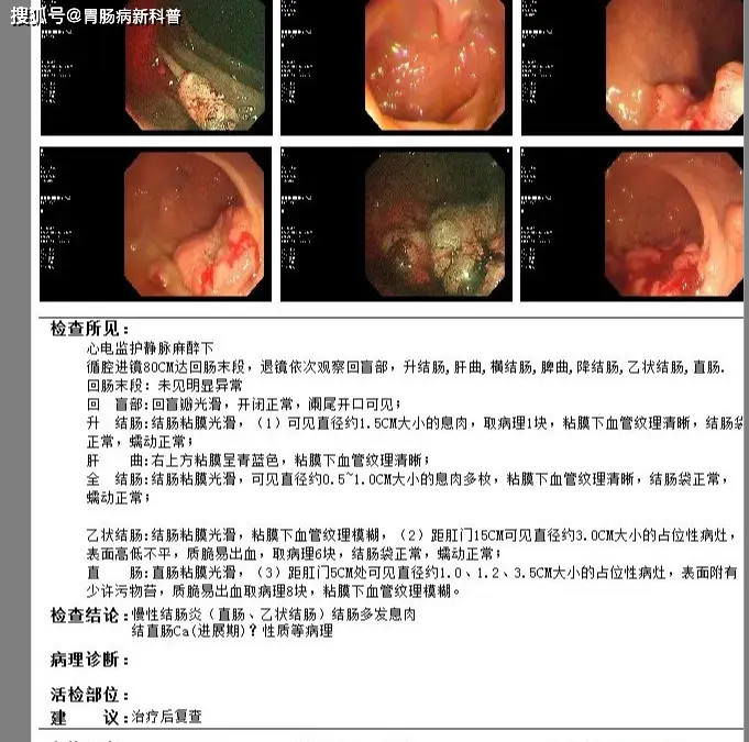 一个不起眼的排便习惯改变，却是晚期直肠癌的“信号”！