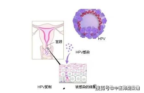 东谈主乳头瘤病毒(HPV)感染多属干冷下注，清热利湿排毒法可治