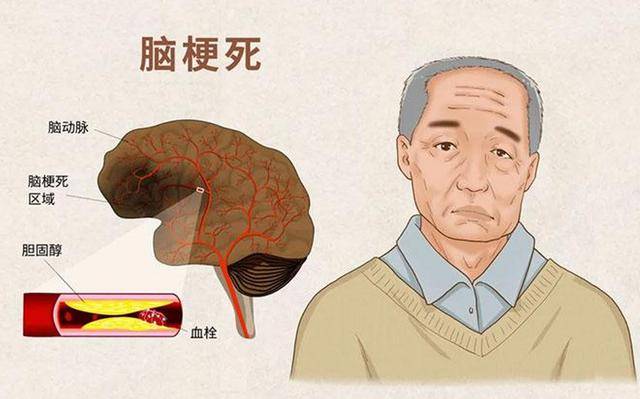 脑梗是“拖”出来的？大夫：就寝时若有3个症状，提议早筛查