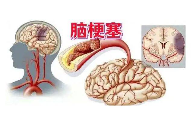 脑梗是怎么来的？提醒：睡觉时若出现3种现象，引起重视