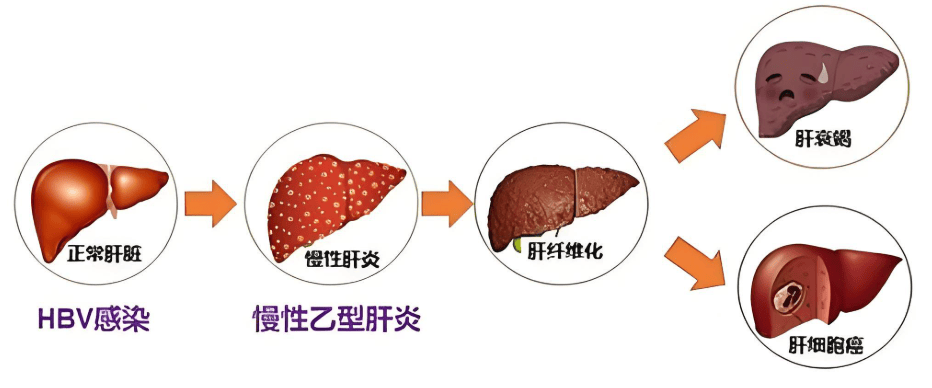 乙肝不想“惹上”肝癌，生活中3个反复异常要留意，早自查早受益