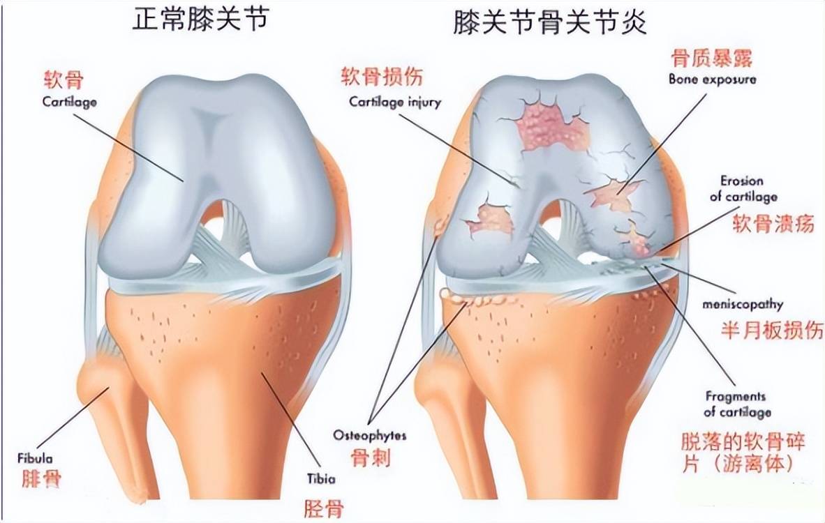 这个病几乎人人躲不开，你知道它是怎么发生的吗？