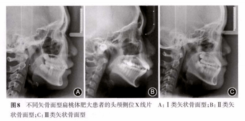 肺腑之言 | 会让人变丑的呼吸方式，你知道吗？