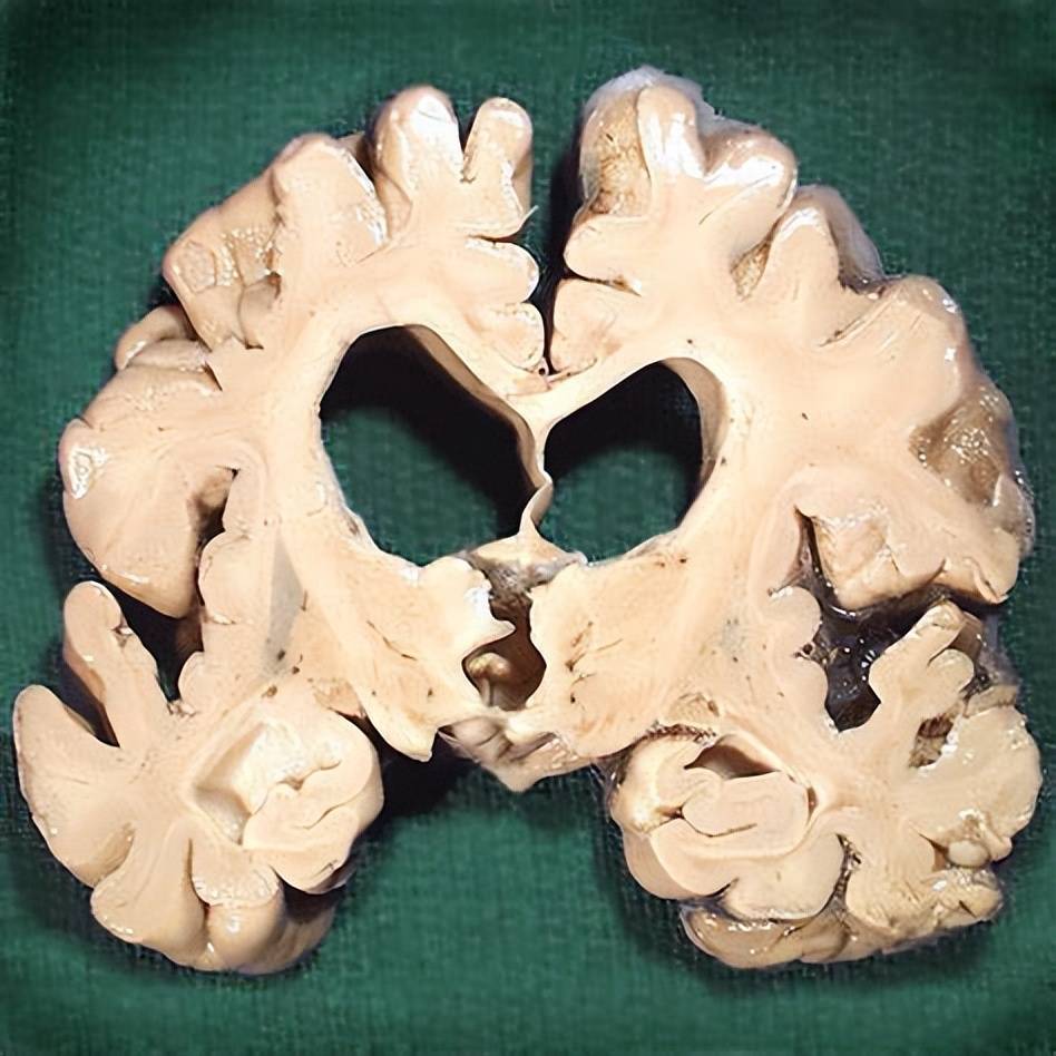 高血压会伤大脑？医生提醒：70%脑卒中患者有高血压，4种疾病最常见