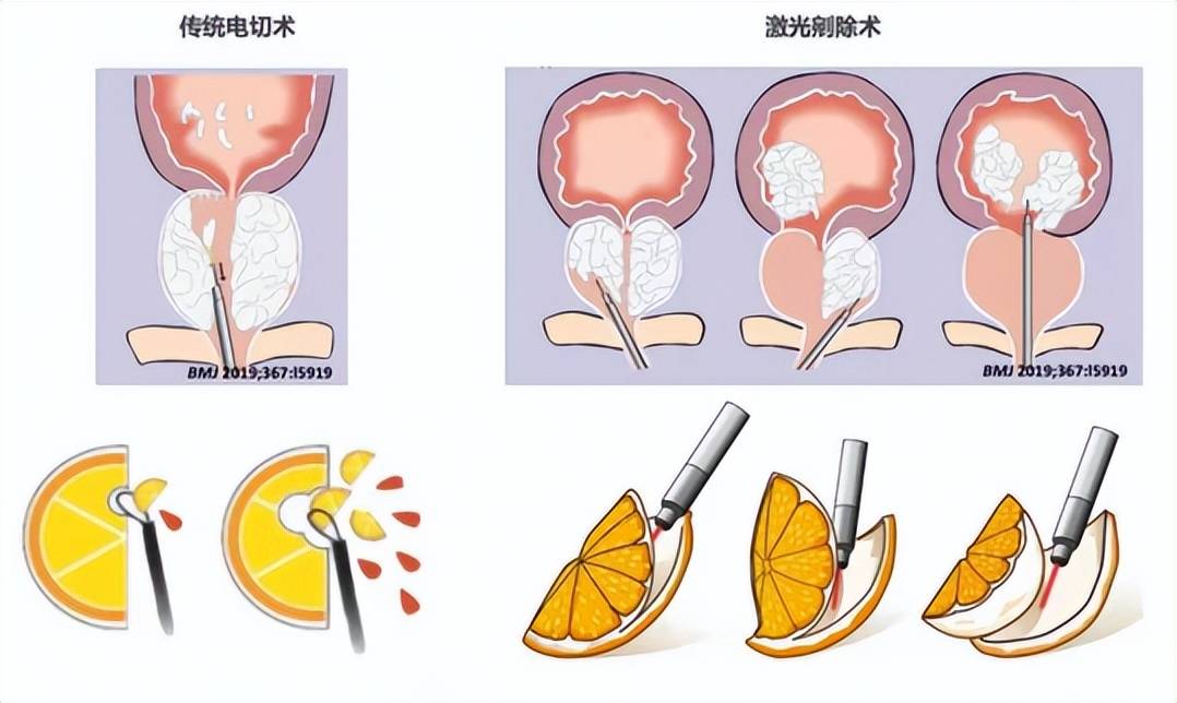 新技术｜从尿道“挖”前列腺，解除“男”言之隐——经尿道前列腺机光剜除术！