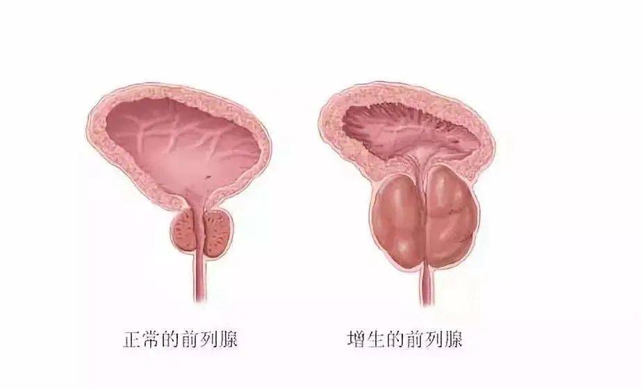 新技术｜从尿道“挖”前列腺，解除“男”言之隐——经尿道前列腺机光剜除术！