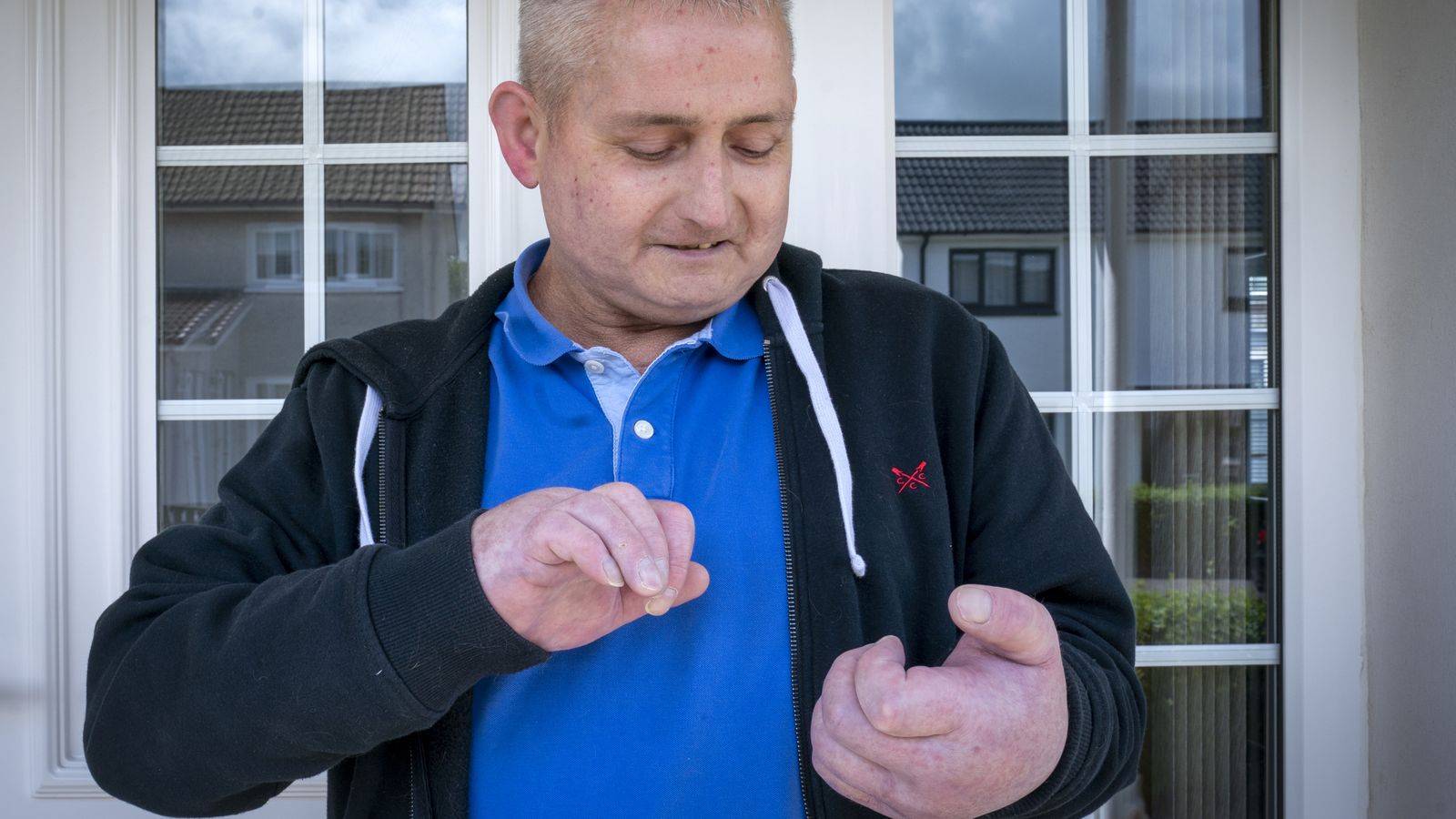 搜狐医要 | 英专家为硬皮病患者移植新的双手，手移植术后能做哪些草作？