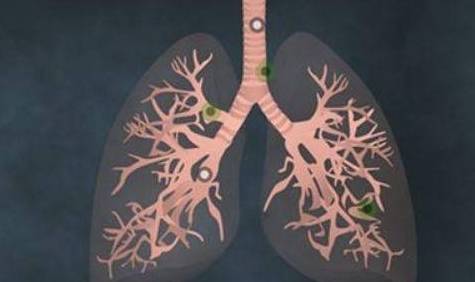 “肺癌”的早期症状，除了干咳，可能还有这2个表现，别忽视了