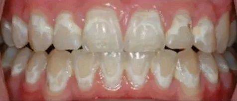 戴牙套会损伤牙齿表面吗？TUO矿是怎么回事？