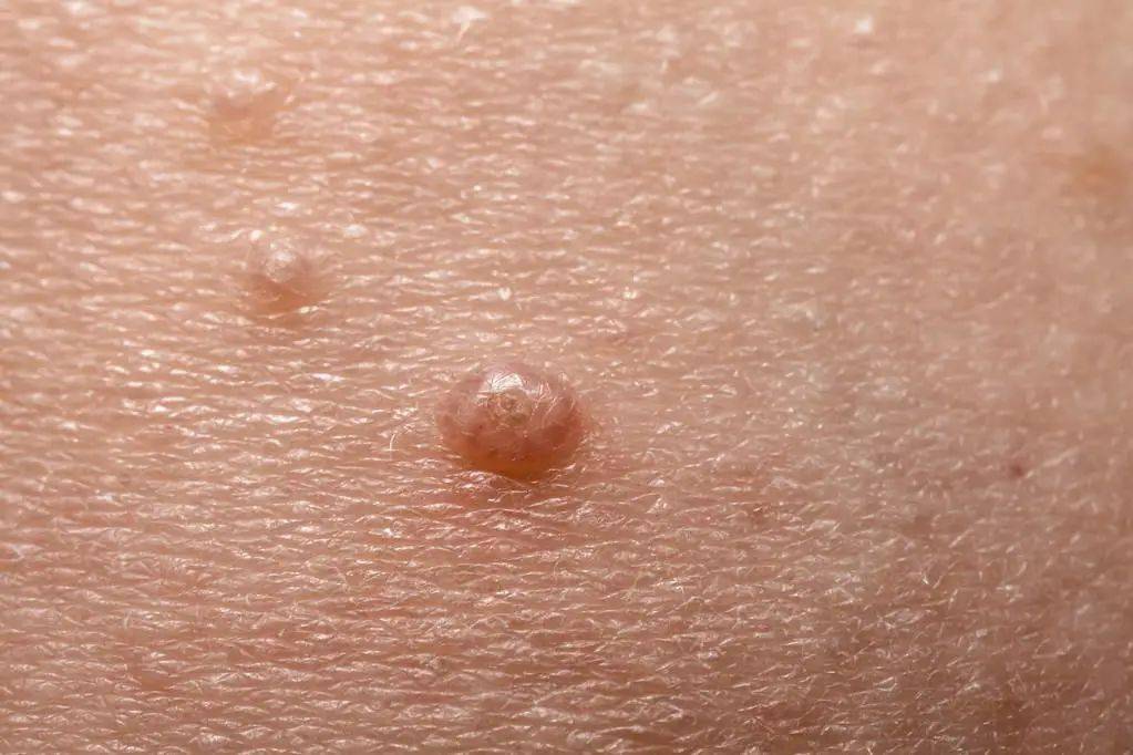 皮肤上的“小肉粒”究竟是什么？