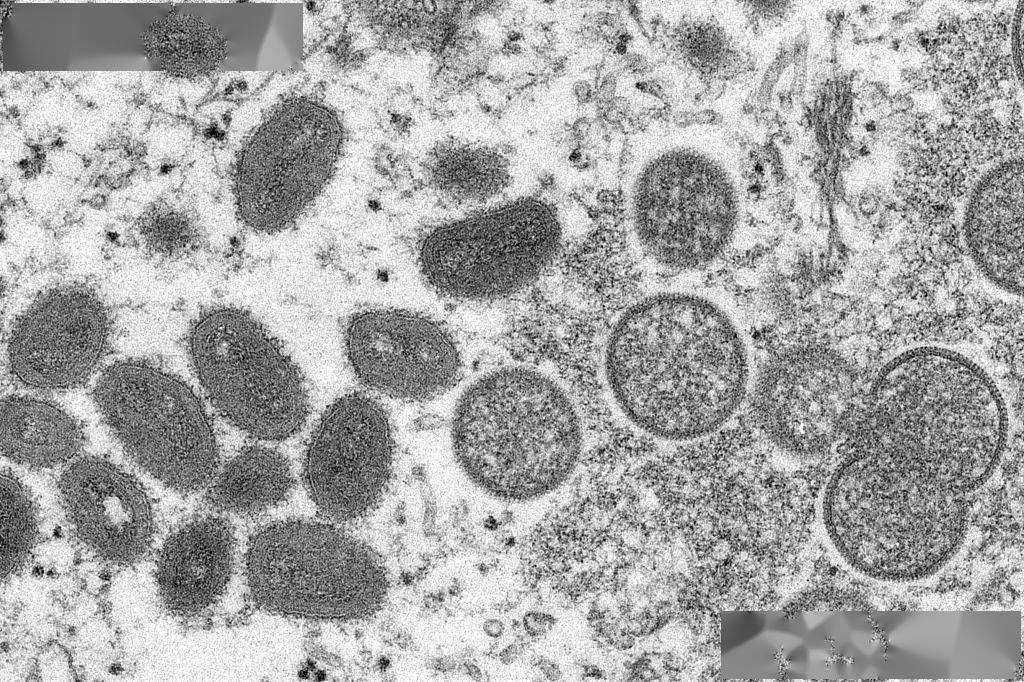 北医三院感染疾病中心 | 关于猴痘，从来源到症状，从预防到治疗，你想知道的，都在这里！