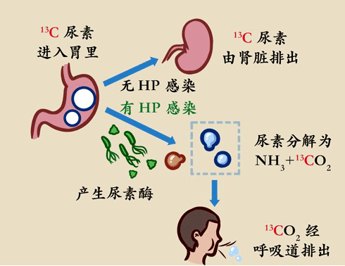 狐大医 | 半数中国人被幽门螺杆菌感染！怎么查，咋预防？