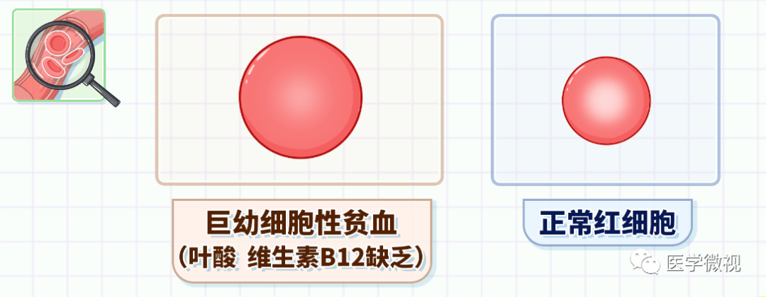 小細胞新貧血:mcv 82fl,mch 27pg,mchc正常或偏小.常見於缺鐵新貧血