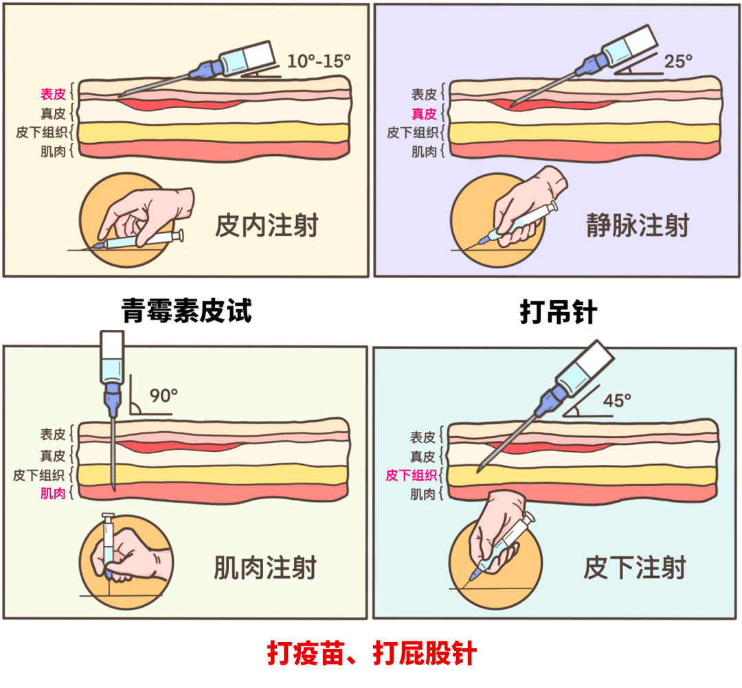 小时候流行的批股针，为啥现在很少了？