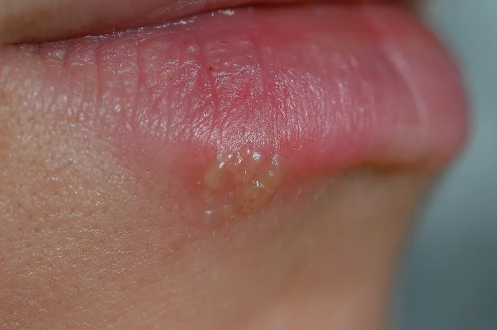 亲嘴的流行，可能造成如今 37 亿人病毒感染
