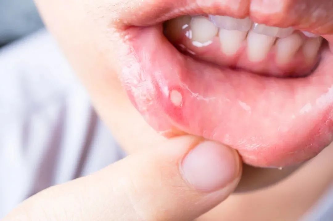 口腔溃疡反反复复，应该怎么治？